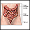 Colostomy - Series