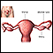 Ligadura de trompas - anatoma uterine