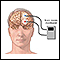 Monitor de ondas cerebrales