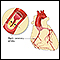 <div class=media-desc><strong>Coronary artery disease</strong><p>The coronary arteries supply blood to the heart muscle itself. Blood supply through these arteries is critical for the heart. Coronary artery disease usually results from the build-up of fatty material and plaque, a condition called atherosclerosis. As the coronary arteries narrow, the flow of blood to the heart can slow or stop, causing chest pain (stable angina), shortness of breath, heart attack, or other symptoms.</p></div>