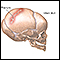 Fractura de cráneo en lactante