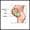 <div class=media-desc><strong>Amniotic fluid</strong><p>Amniotic fluid surrounds the growing fetus in the womb and protects the fetus from injury and temperature changes.  It also allows for freedom of fetal movement and permits musculoskeletal development.  The amniotic fluid can be withdrawn in a procedure called amniocentsis to check for chromosomal defects or other abnormalities.</p></div>