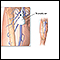 Ultrasonografía Doppler de una extremidad