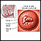 <div class=media-desc><strong>Pap smears and cervical cancer</strong><p>An instrument called a speculum holds the walls of the vagina open so that the cervix may be viewed and a swab of cells obtained for analysis.</p></div>