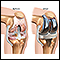 Prótesis de reemplazo de la articulación de la rodilla
